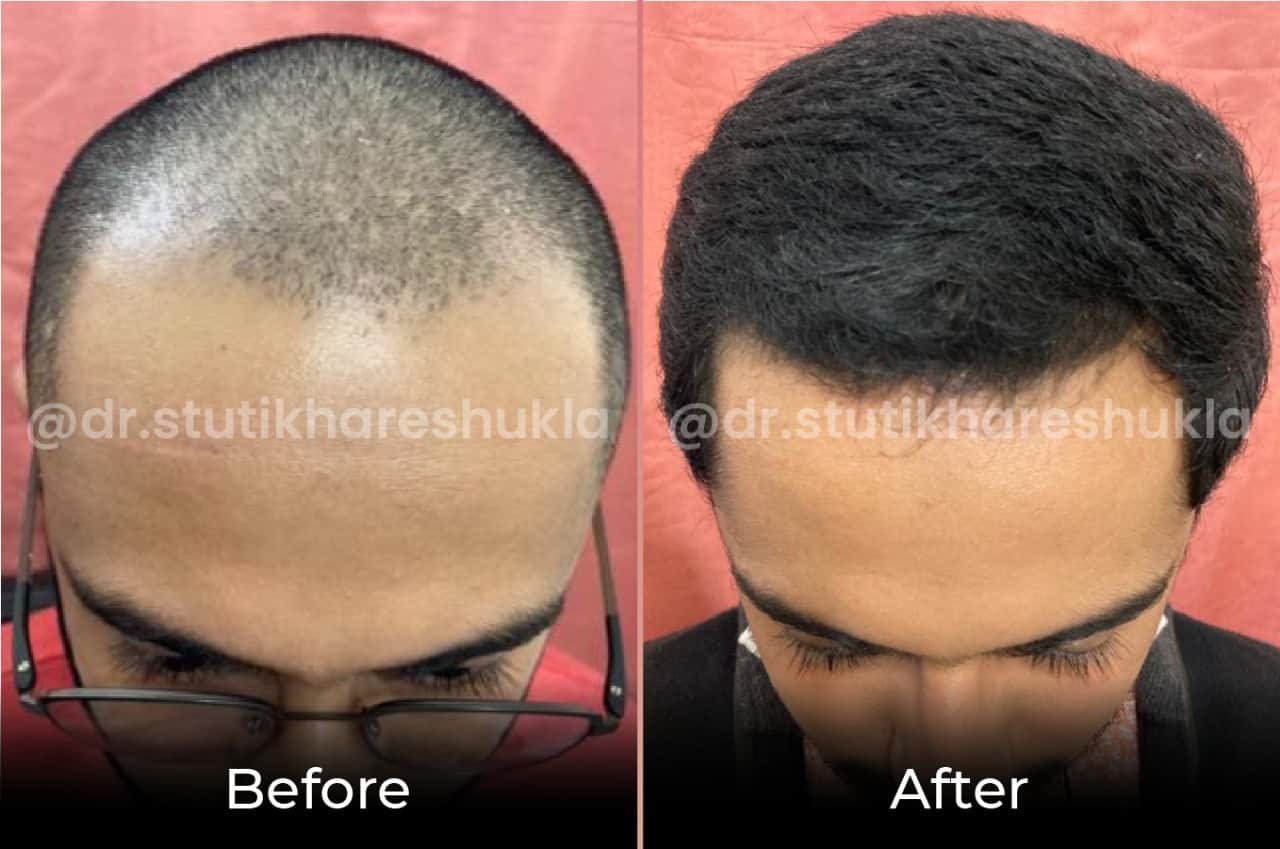 Non Surgical Hair Growth Treatment | Dr Stuti Khare Shukla